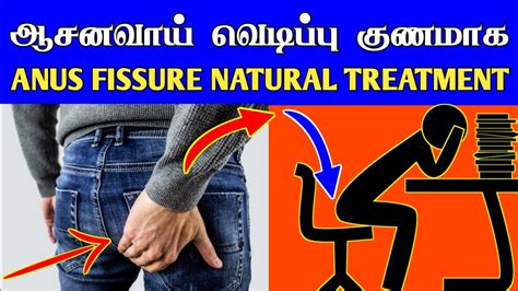 anal fissure meaning in tamil|ஆசனவாய் வெடிப்பு: சிகிச்சை, .